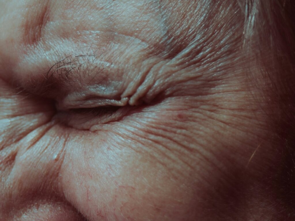 Exaggerated Skin What Rare Genetic Disorder Causes Abnormal Thickening Of Skin? – Health ...